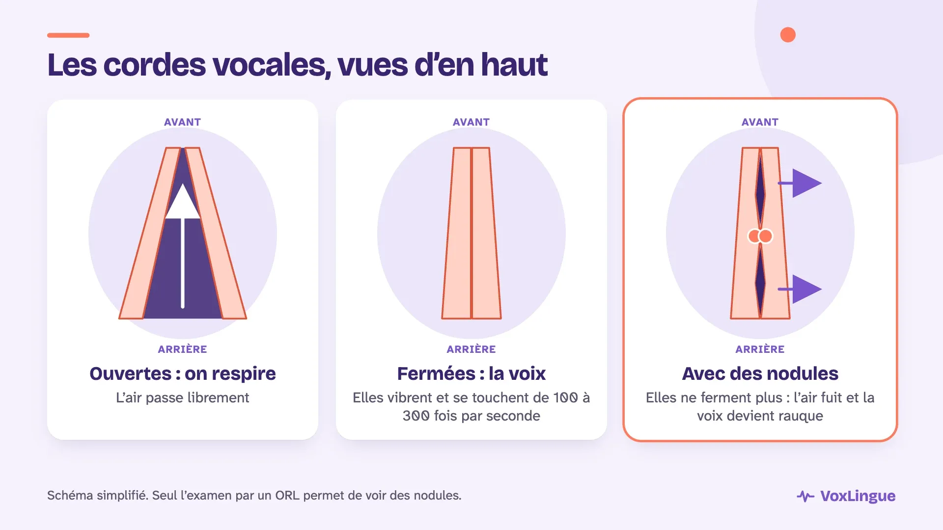Schéma des cordes vocales vues d’en haut : ouvertes pour respirer, fermées pour parler, et avec des nodules qui les empêchent de fermer, ce qui laisse fuir l’air et rend la voix rauque