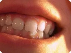 Close-up of teeth with an overbite: upper front teeth overlapping the lower teeth