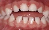Close-up of teeth with an open bite: a gap between upper and lower front teeth