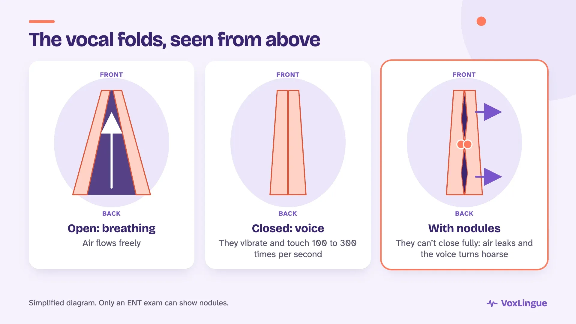 Diagram of the vocal folds seen from above: open for breathing, closed for speaking, and with nodules that keep them from closing, so air leaks and the voice sounds hoarse